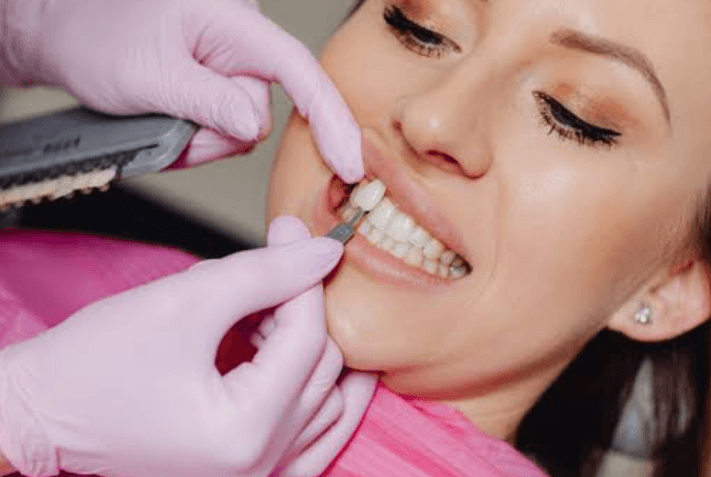 Dental Veneers Teeth: A Practical Guide to Improving Your Smile